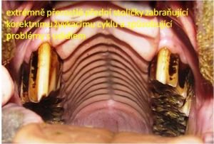 přerostlé  přední stoličky